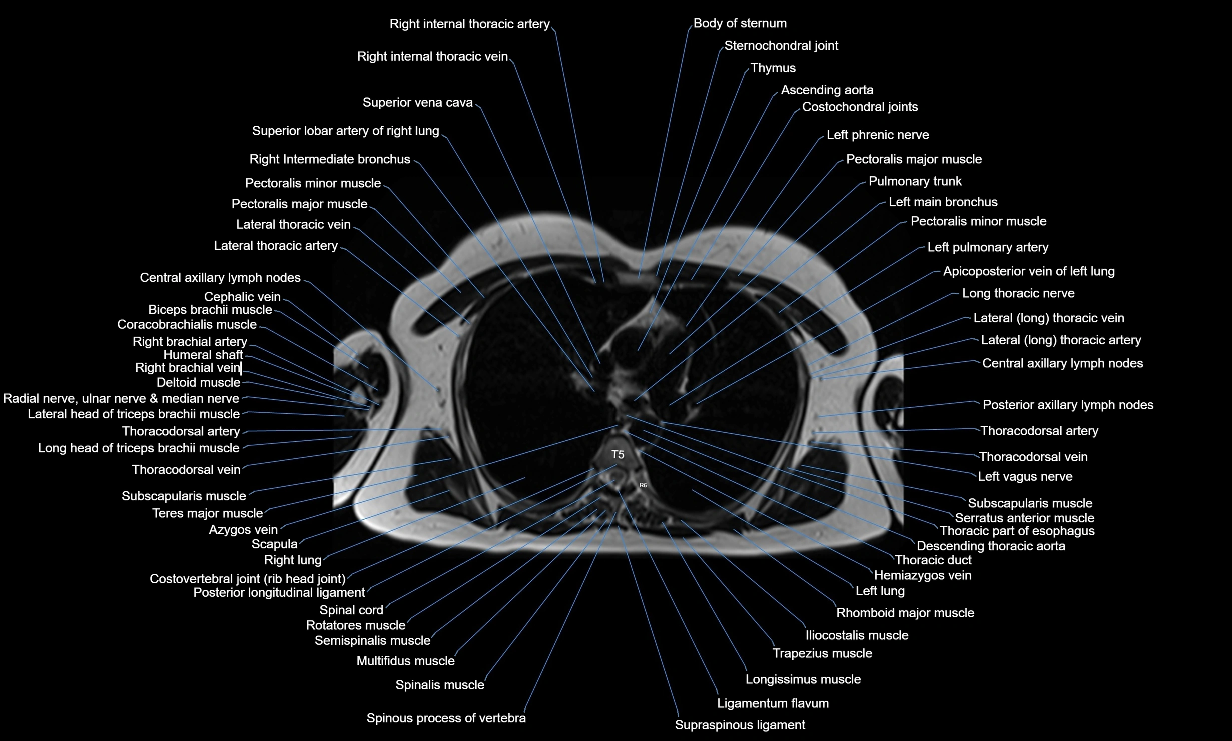 MRI chest axial  cross sectional anatomy 3T radiology  image-img-00001-00019.webp